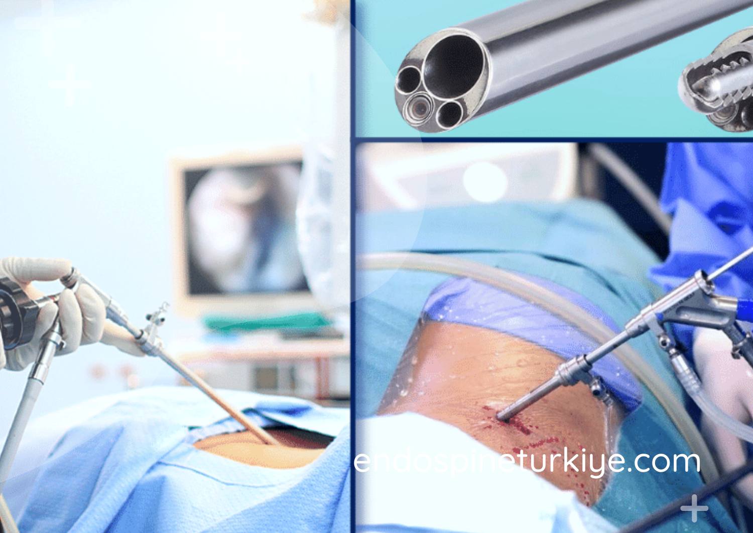 Tam Kapalı Endoskopik Bel Fıtığı Ameliyatı